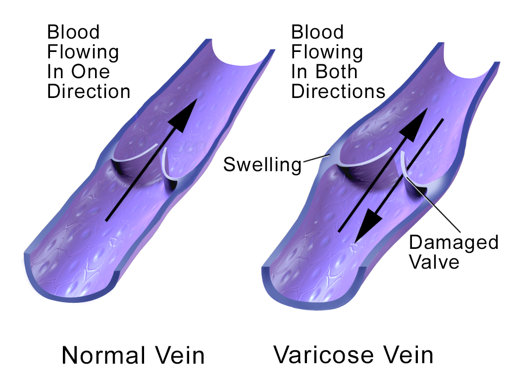 Varicose Veins Pittsburgh | Varicose Vein Treatment Sewickley PA