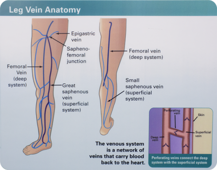 Varicose Veins Treatment Pittsburgh | Sewickley PA