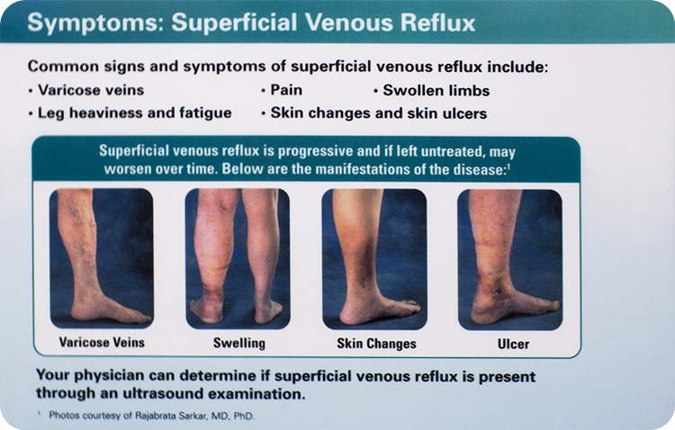 Varicose Veins Pittsburgh | Varicose Vein Treatment Sewickley PA