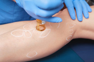 Sclerotherapy Treatment Pittsburgh, PA | Sewickley