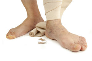 Lymphedema Pittsburgh | Sewickley, PA 