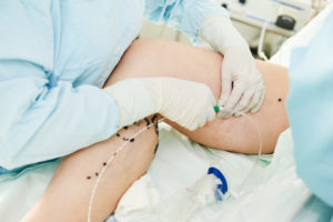 varicose veins treatment