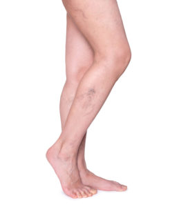 Varicose Vein Treatment Sewickley | Beaver PA